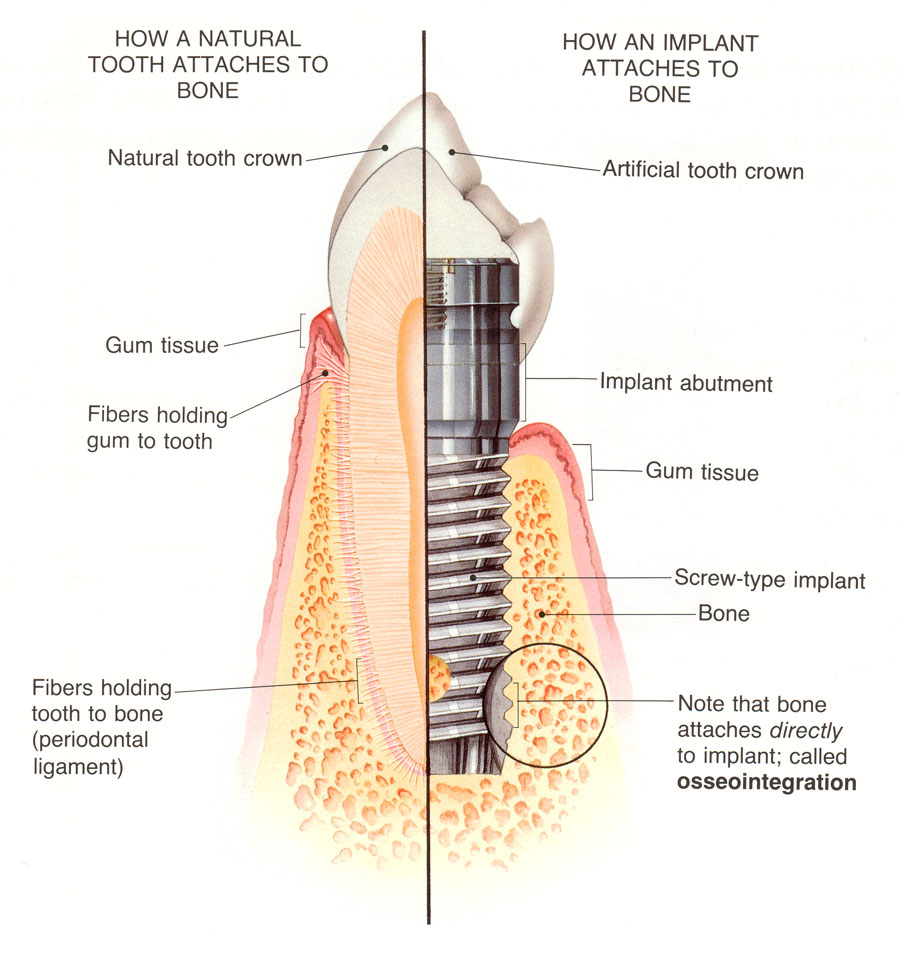 osseointegration how an implant attaches to the bone