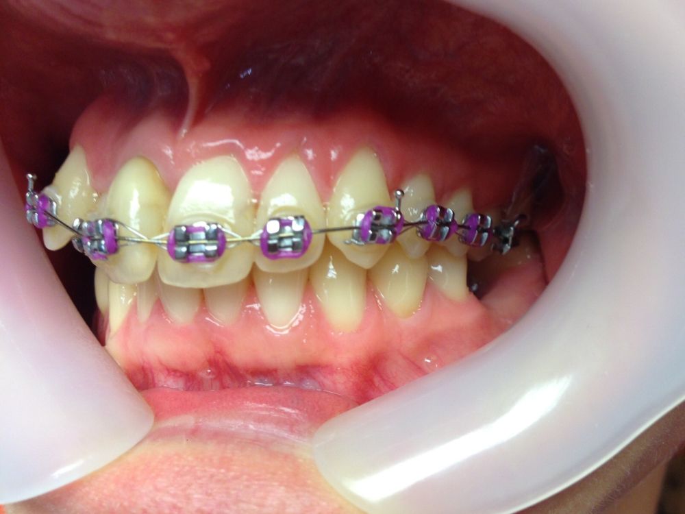 Metallic Braces Purple 1