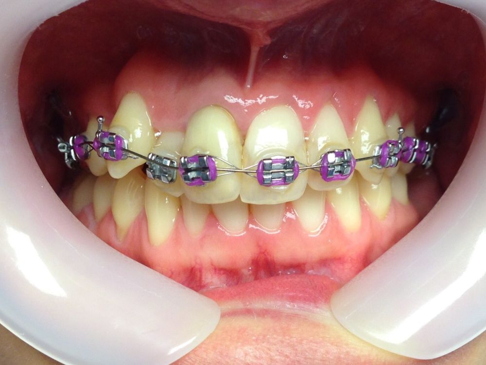 Metallic Braces Purple 2