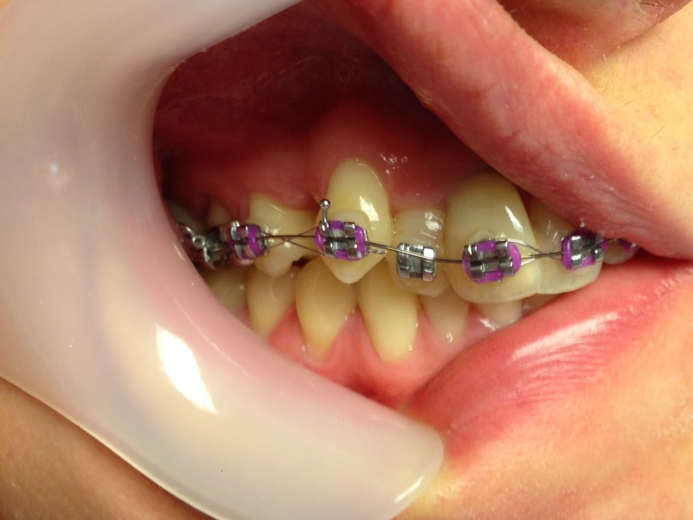 Metallic Braces Purple 3