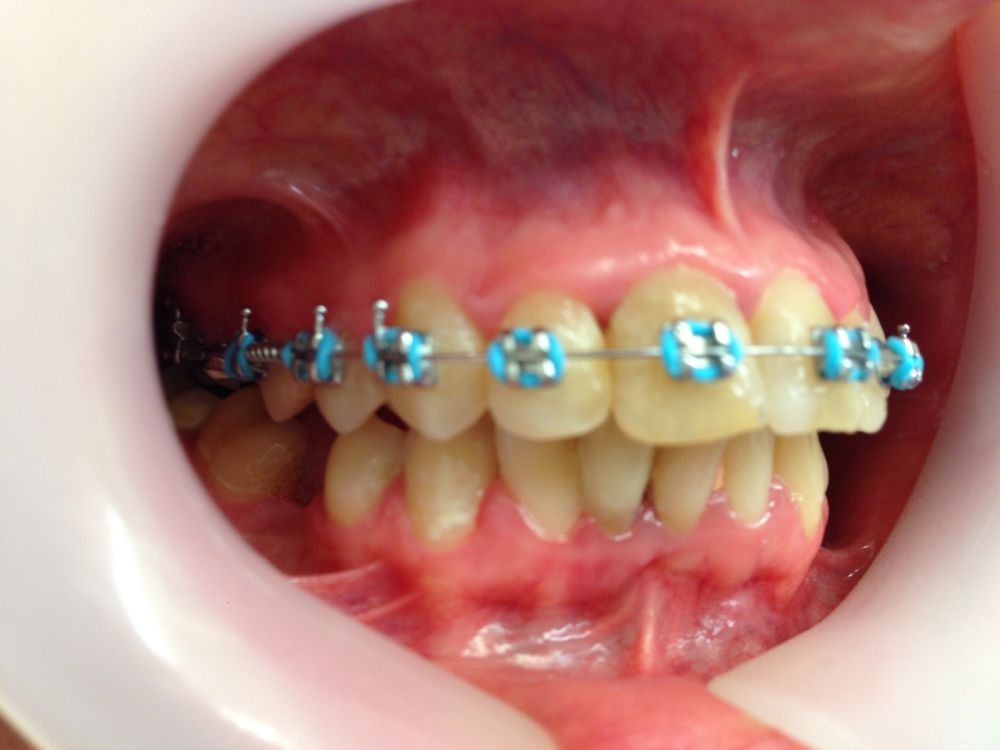 Metallic Braces Blue 1