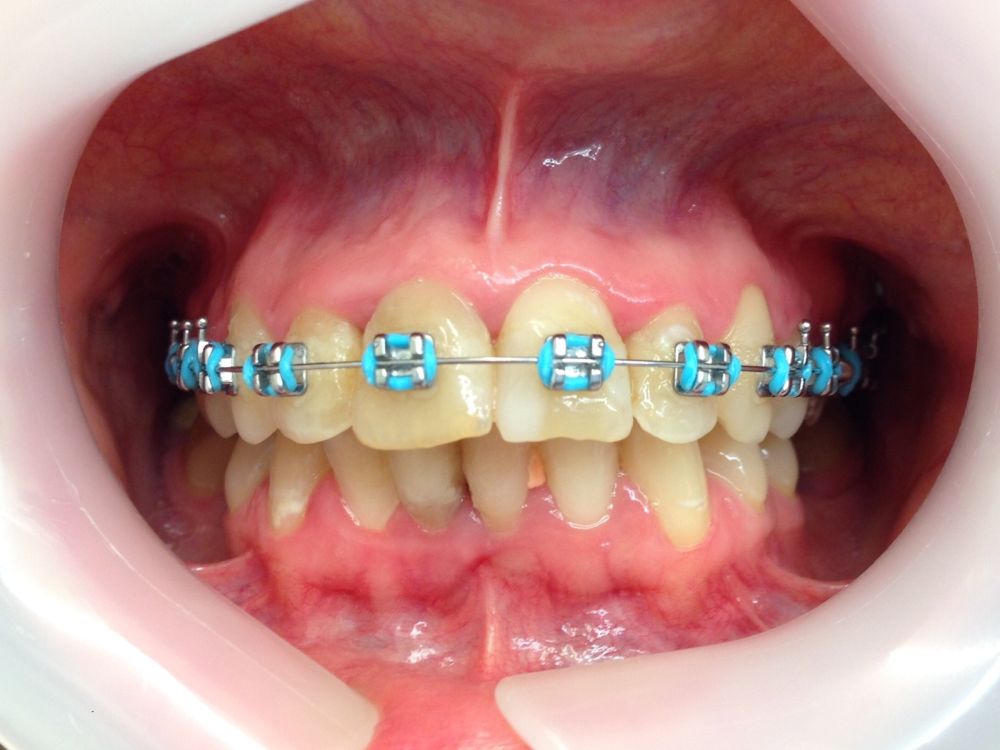 Metallic Braces Blue 2